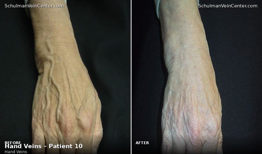 Hand Veins – Patient 10