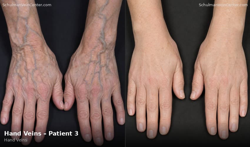 Hand Veins – Patient 3