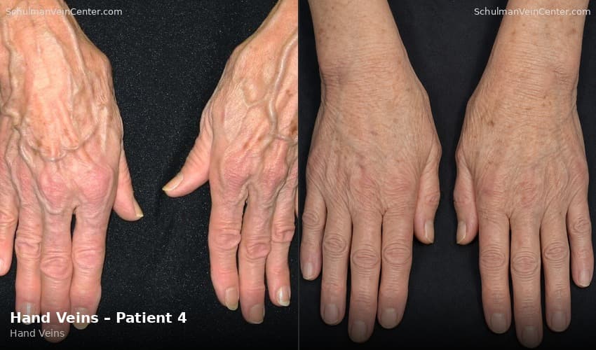 Hand Veins – Patient 4