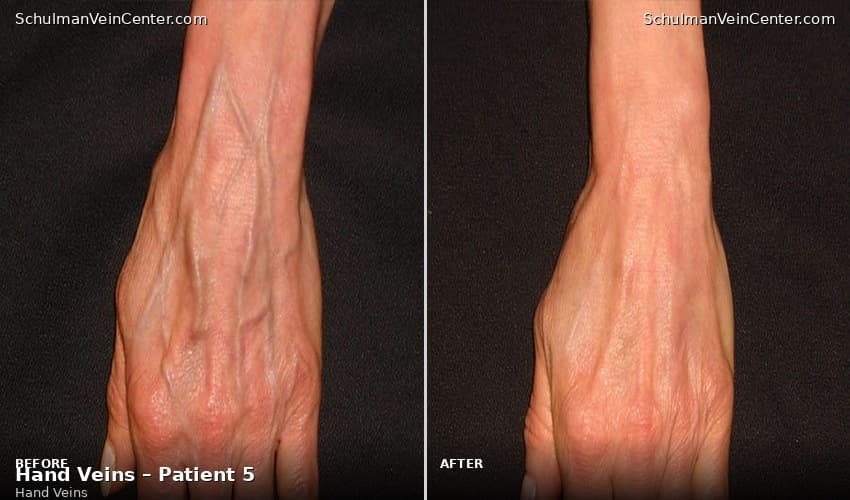Hand Veins – Patient 5