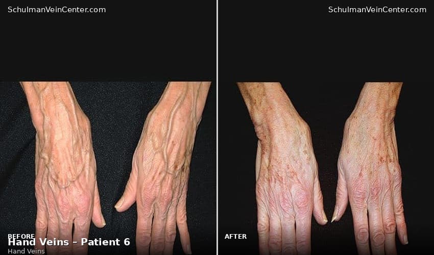 Hand Veins – Patient 6