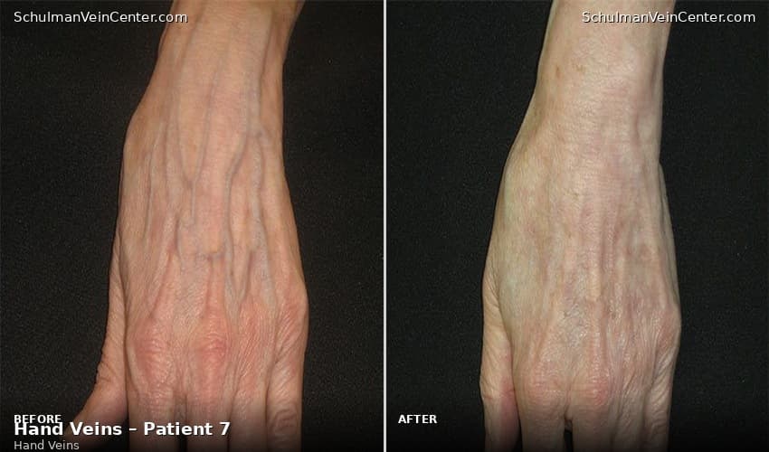 Hand Veins – Patient 7