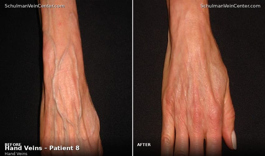 Hand Veins – Patient 8