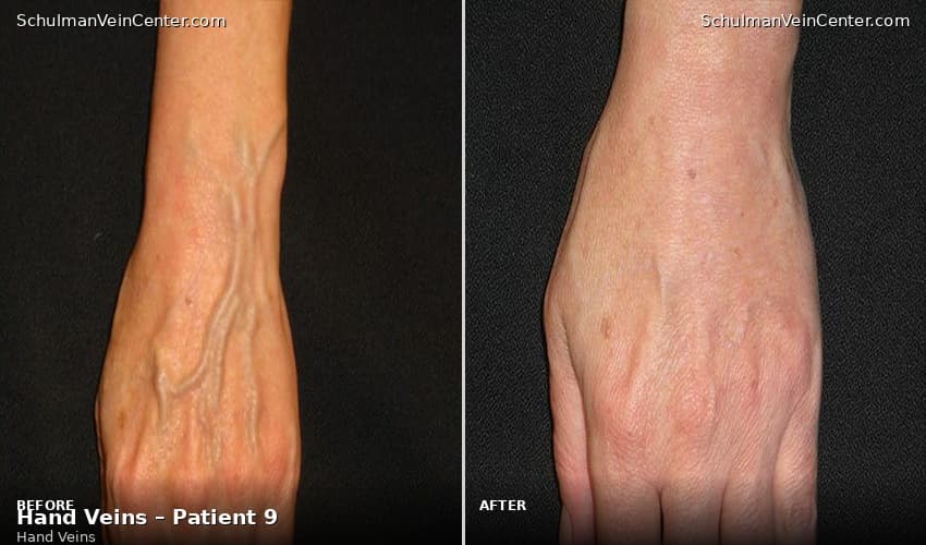 Hand Veins – Patient 9