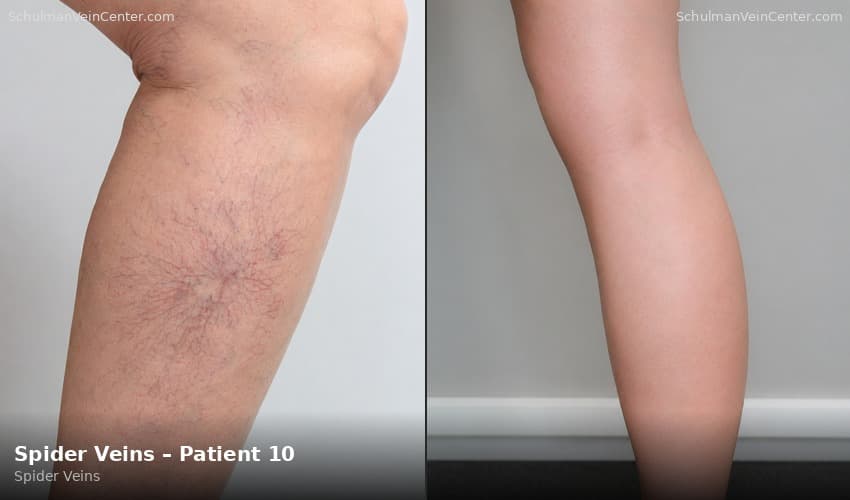 Spider Veins – Patient 10