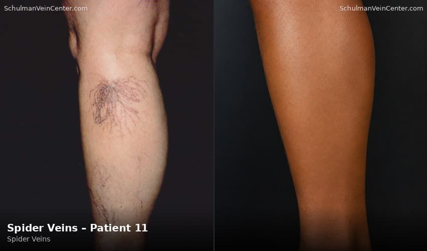 Spider Veins – Patient 11