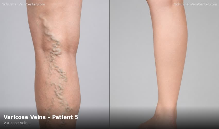 Varicose Veins – Patient 5