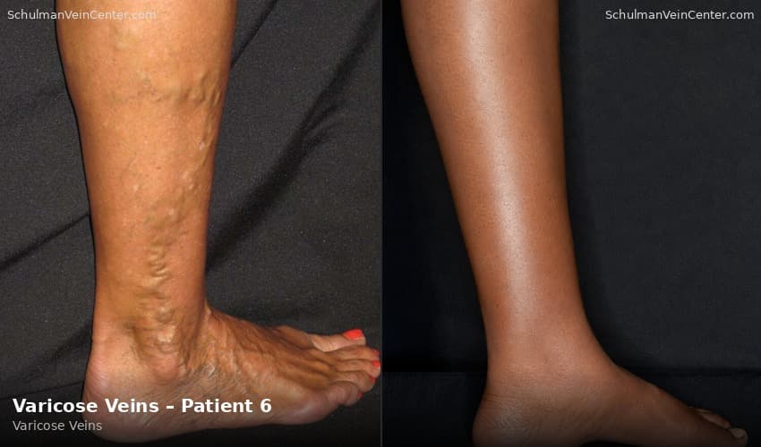 Varicose Veins – Patient 6