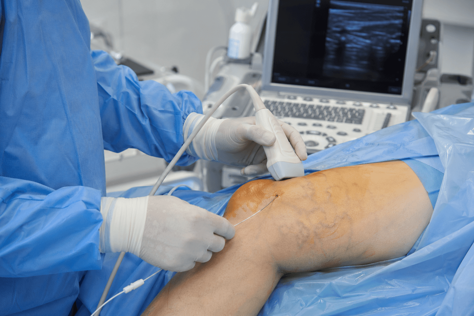 Doctor performing EVLT laser vein procedure with ultrasound guidance