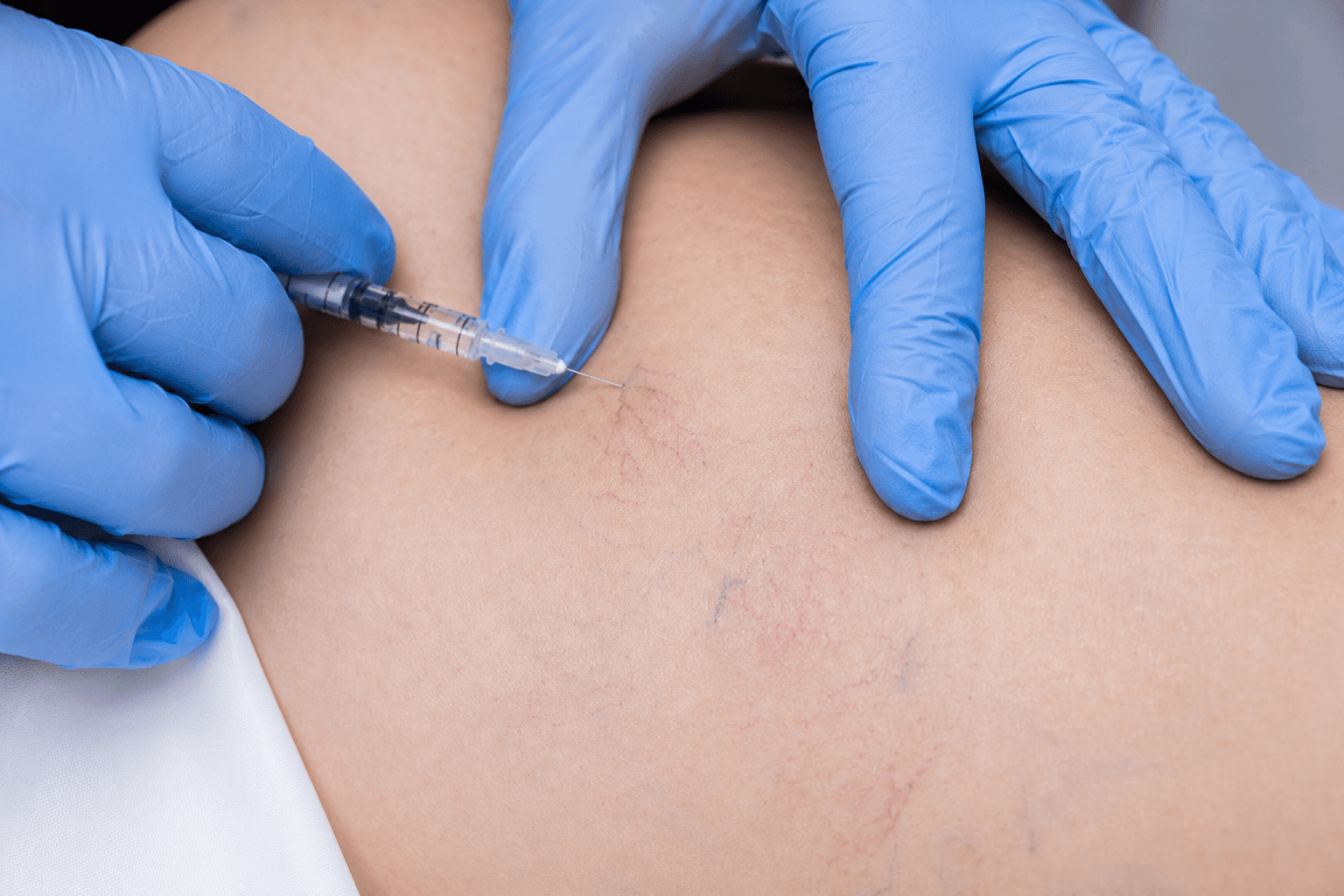 Dermatologist performing sclerotherapy injection on spider veins