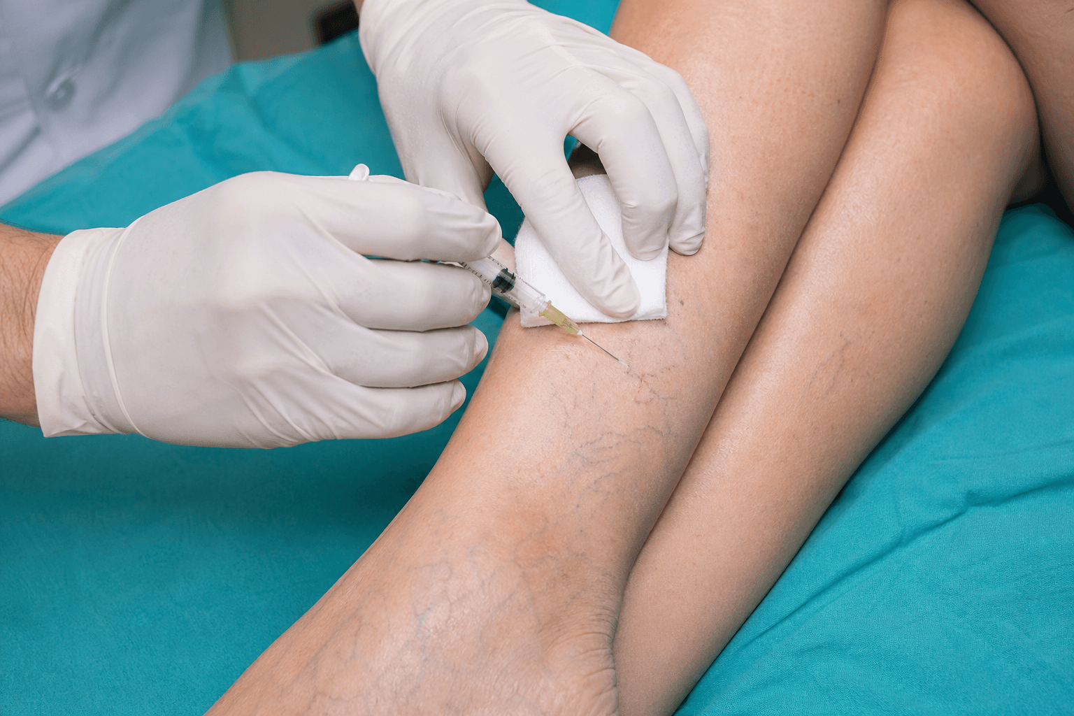 Physician performing sclerotherapy injection on varicose veins