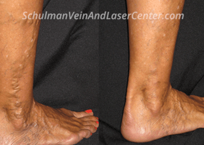 Varicose vein symptom checklist with leg illustration — when to seek treatment in New York