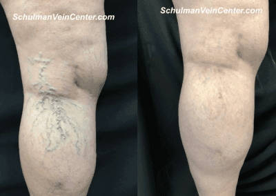 Spider Veins – Patient 8