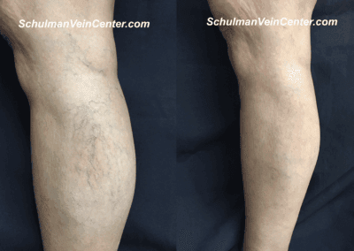 Varicose veins vs spider veins diagram - vein treatment New York