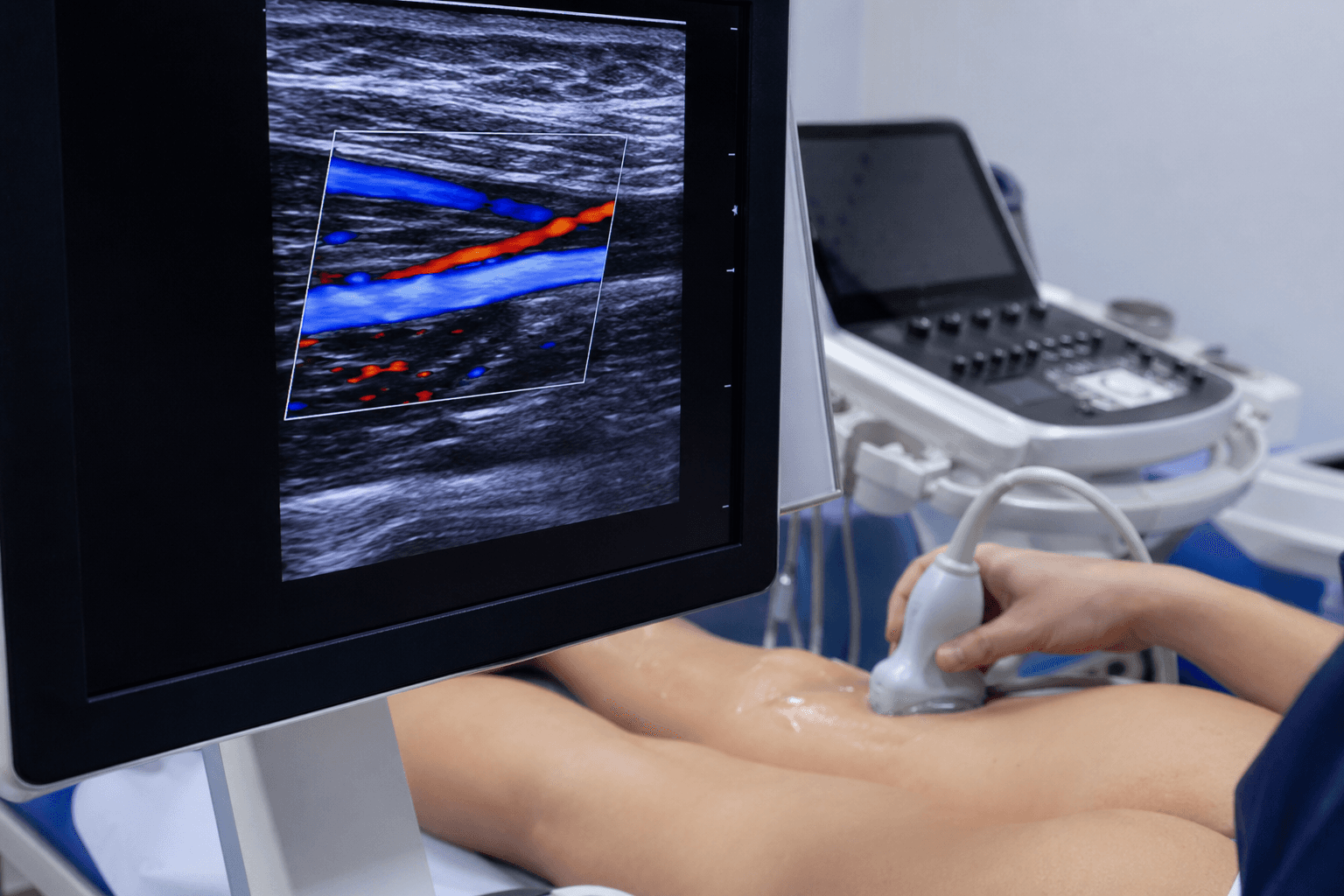 Color Doppler ultrasound vein mapping during a vein screening