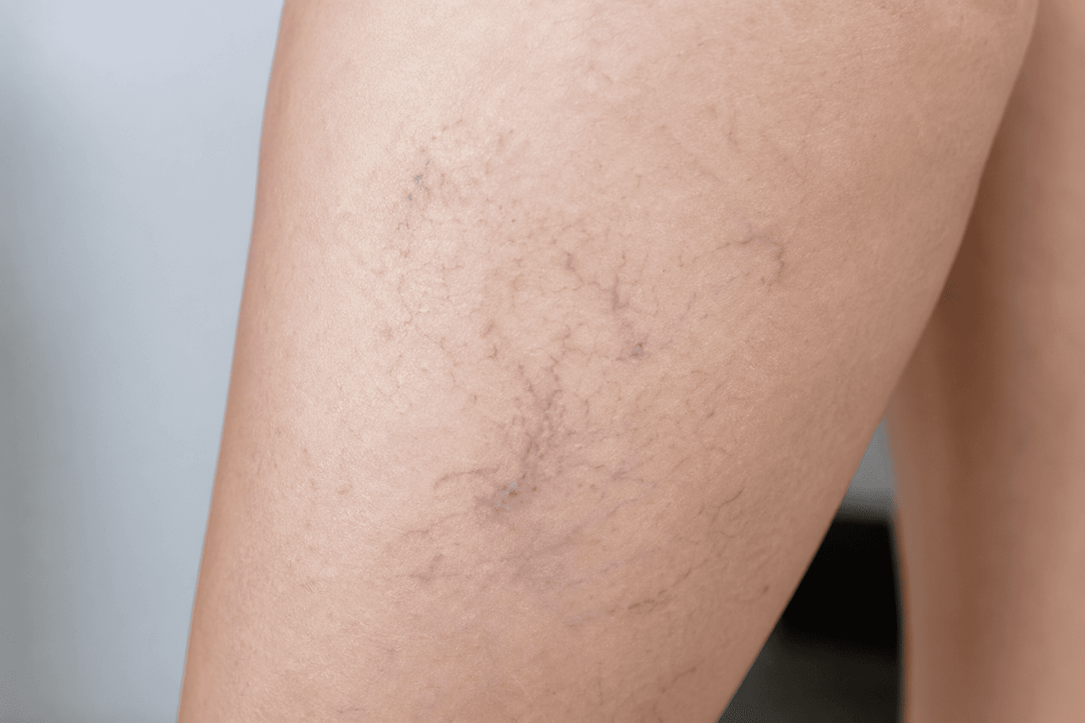 Close-up of spider veins on a patient's thigh showing red and purple vein patterns