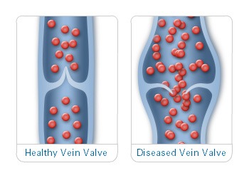 Understanding Your Leg Veins