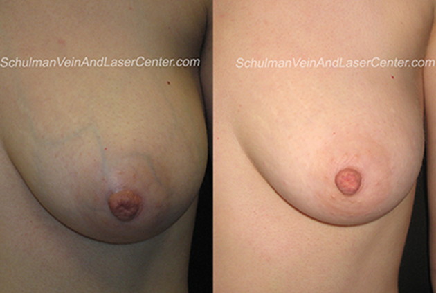 Breast Veins Patient 2