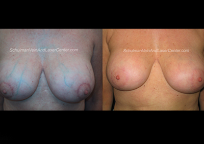 Breast Vein Removal (After Breast Lift Surgery)