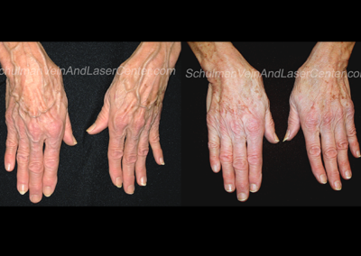 Hand Veins Patient 3