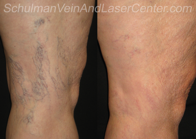 Spider Veins Patient 1