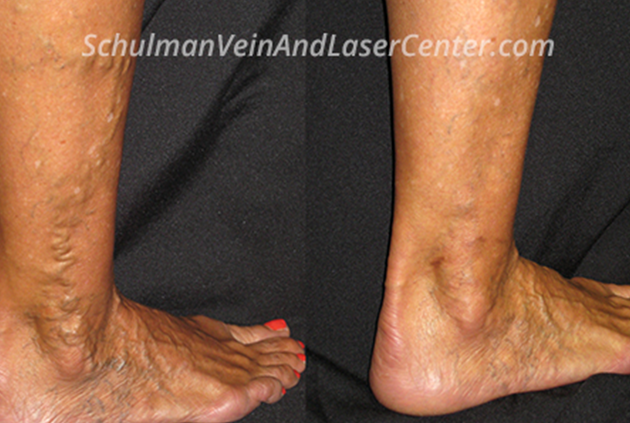 Enlarged Varicose Veins