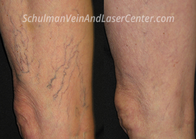 Spider Veins Patient 3