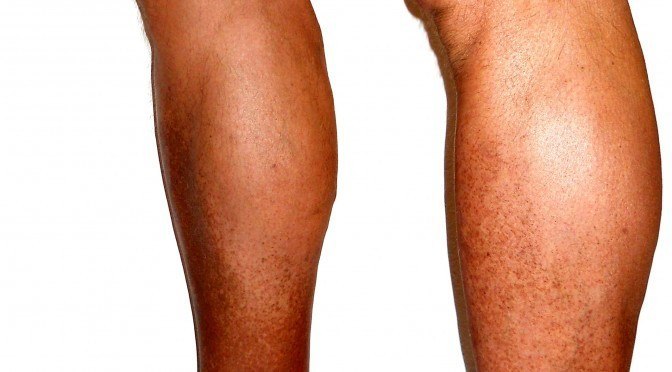 Are the pains in your legs from Venous Insufficiency?