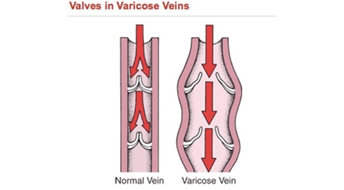 Varicose Veins And Vein Valves