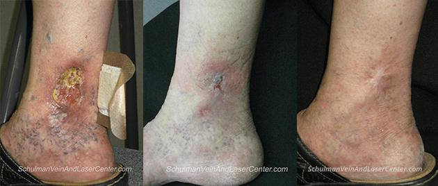 Treat Varicose Veins Early To Avoid Future Problems Such As Venous Leg Ulcers