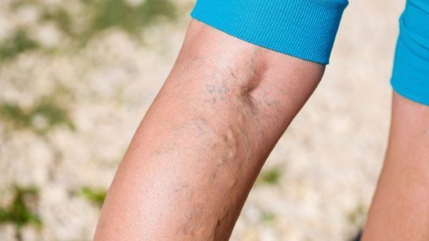 Three  Types Of People At Risk For  Developing Varicose Veins