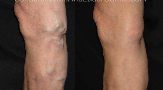 Why You Really Need To See A Varicose Vein Specialist In New York