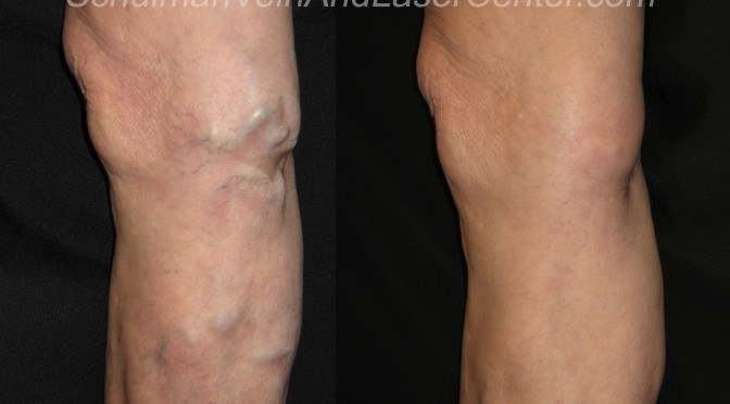 Varicose Veins Around the Knees