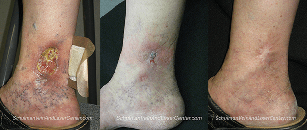 What Are Some Complications Of Leg Veins If Left Untreated ?