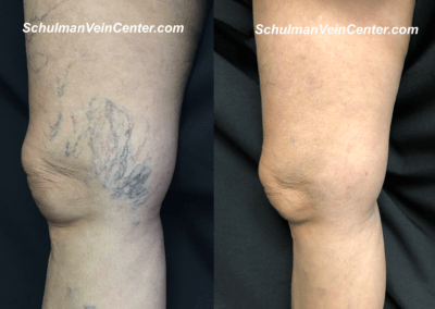 Spider Veins Patient 6