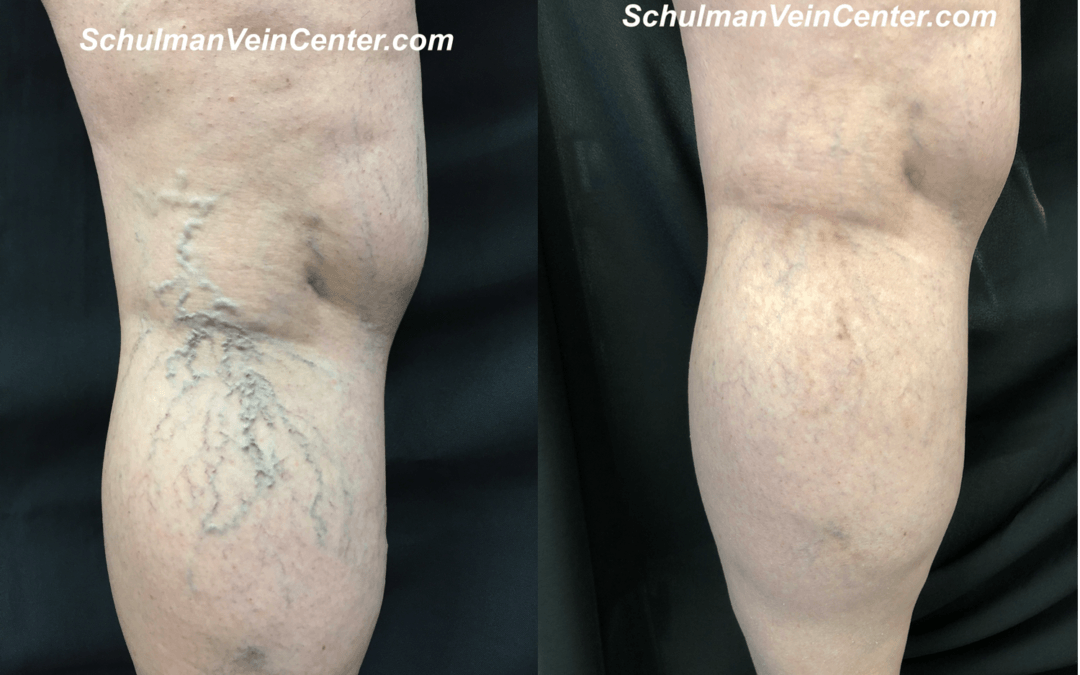 Spider Veins Patient 8