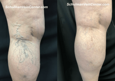 Spider Veins Patient 8