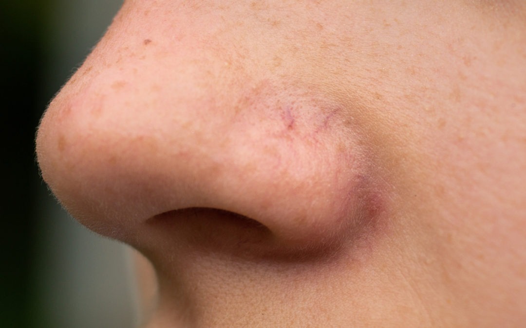 face redness spider veins