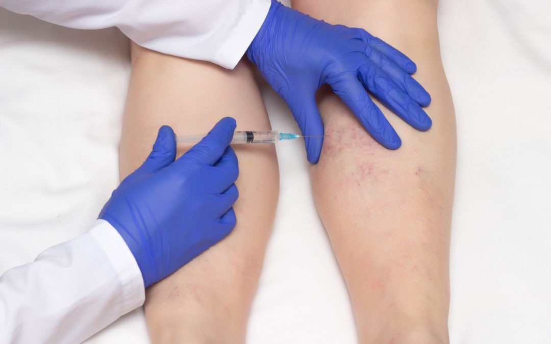 Treat Your Spider Veins with Schulman Vein in Manhattan